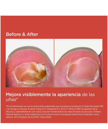 SI-NAILS MICROEXPERT MD