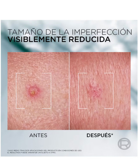 L’ORÉAL MEN DERMA CONTROL S.O.S PIMPLE PASTE