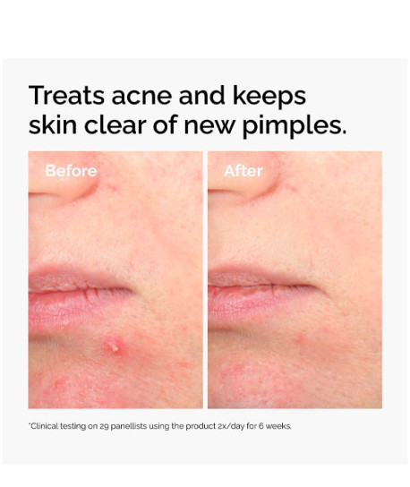 SALICYLIC ACID 2% SOLUTION